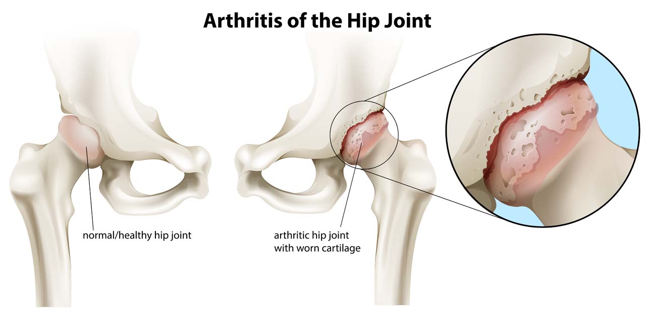 Illustration of the arthritis of the hip joint
