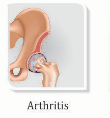 Hip pain due to Arthritis