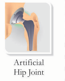 Artificial Hip Joint for Hip Replacement